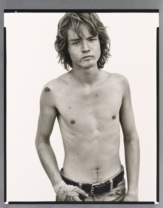 A black-and-white portrait photograph of a shirtless White man with an acne-scarred face, long  wavy hair, wearing jeans, and with one hand wrapped in bandages.