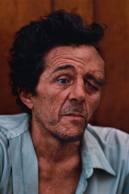 A color portrait photograph of a White man with dark hair and stubble on his face, a large swelling over his left eye, wearing a blue-collared shirt.