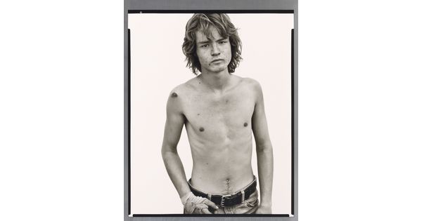 A black-and-white portrait photograph of a shirtless White man with an acne-scarred face, long  wavy hair, wearing jeans, and with one hand wrapped in bandages.