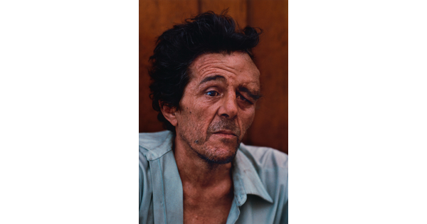 A color portrait photograph of a White man with dark hair and stubble on his face, a large swelling over his left eye, wearing a blue-collared shirt.